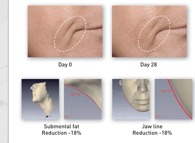 Day 0 and Day 28 photographs of the jaw line, with 3D scans showing an 18 percent reduction in submental fat and jaw line
